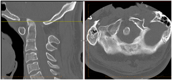 Basilar invagination 