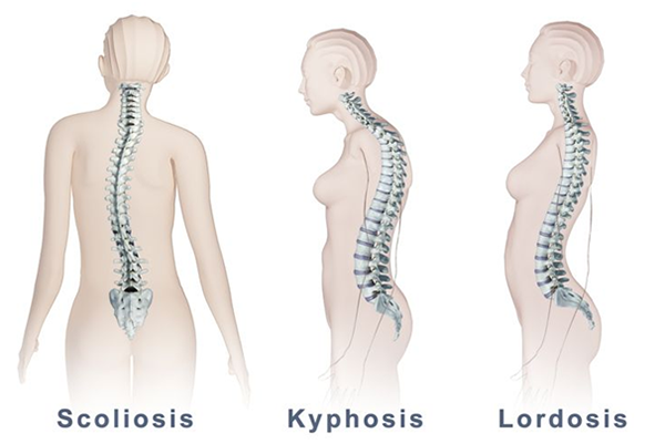 Degenerative Scoliosis