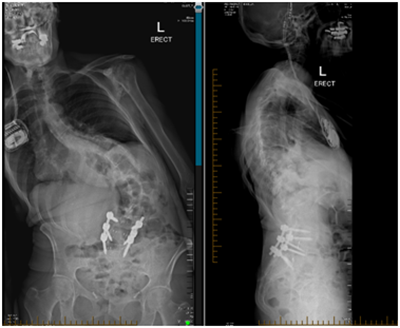 Degenerative Scoliosis