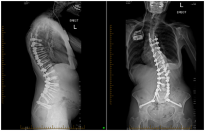 Degenerative Scoliosis