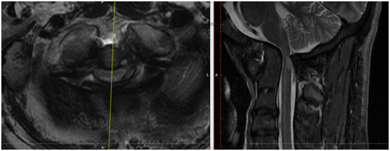 Basilar invagination 