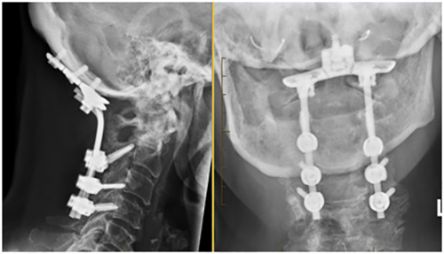 Basilar invagination 