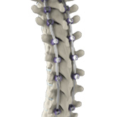 Complex Spine Surgery