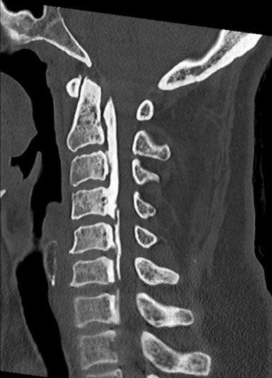 OSSIFICATION OF THE POSTERIOR LONGITUDINAL LIGAMENT