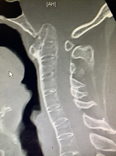 Rheumatoid Spine