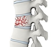 Spinal Trauma