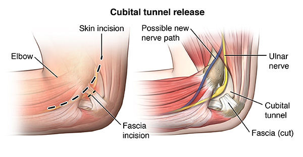 Ulnar Nerve Release Cincinnati OH  Ulnar Nerve Decompression West Chester,  OH