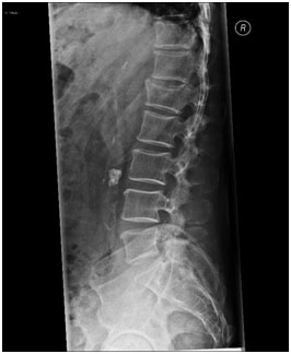 Physical Therapy in our clinic for Spinal Compression Fractures