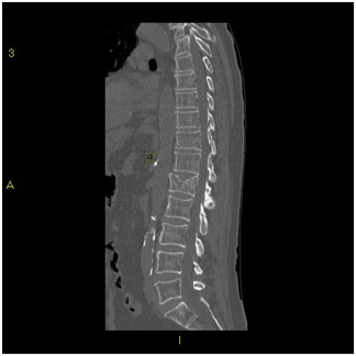 Vertebral Compression Fractures Pain Treatment Westmead, NSW